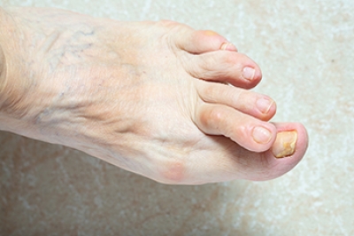 Causes and Associated Conditions of Hammertoe